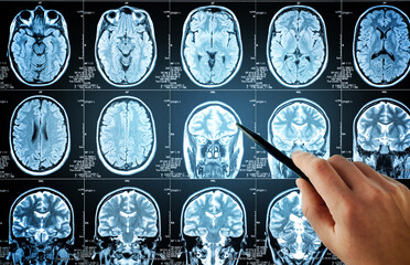 The doctor is doing a brain. Closeup of a CT scan with brain. Magnetic resonance imaging. Medical, science and education mri brain background. Magnetic resonance imaging.
