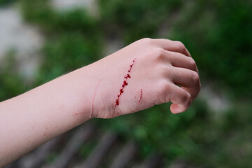 Injury on the Arm with a Streak of Blood Visible, Calling for Immediate Attention and Care