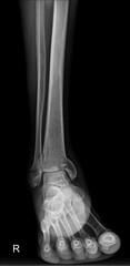 lateral view of a right ankle and foot