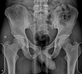 X-ray of the pelvis and hips