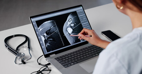 Surgeon Analyzing MRI Results On Computer