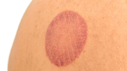 Fototapeta premium Circular Discoloration on Skin Depicting Cupping Therapy Markings Post Treatment Session