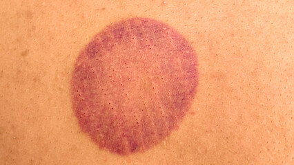 A circular mark on human skin, indicative of cupping therapy. The purplish discoloration reveals...