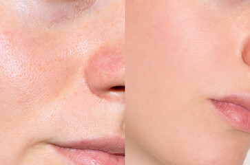 Close-up comparison of facial skin before and after pore treatment, showing smoother and healthier...