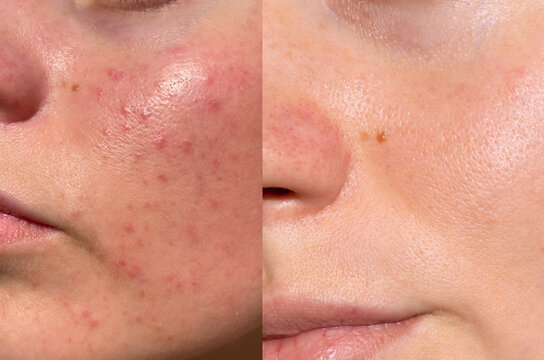 Macro close-up showing acne-prone skin before and after treatment, highlighting smoother and clearer facial texture, dermatology and skincare result concept.