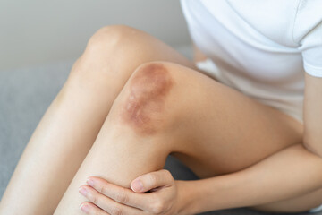 Close up of stain bruise wound on arm, contusion asian young woman, girl an accident fell down...