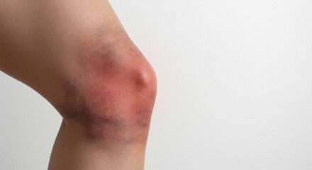 Injured knee with bruising on skin against a neutral background  