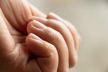 Finger with rash and skin irritation from allergies on a girl's hand
