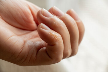 Finger with rash and skin irritation from allergies on a girl's hand