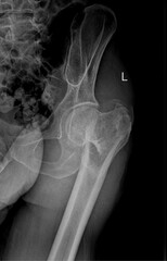 Fototapeta premium X-ray of the left hip joint, including the femoral head, acetabulum, and surrounding pelvis. showing hip fracture 