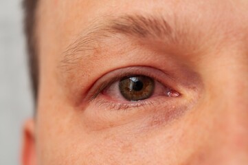A close-up of an eye exhibiting symptoms of conjunctivitis, with visible redness and irritation.