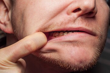 Close-up view of a man's mouth, highlighting the condition of his teeth, pulled open by a finger