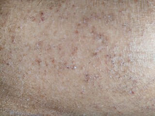 Close-up of dry, scaly skin with small red lesions, which is typical of an allergic reaction or...