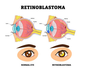 Retinoblastoma Rare Eye Cancer, Eye Vision Problem, Eye Disease for Educational Medical Poster Design Healthcare Scheme, Eye Illness and Eyesight Problem,  Medical Retina Health. Fovea