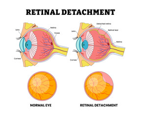 Retinal Detachment Eye Vision Problem, Eye Disease for Educational Medical Poster Design Healthcare Scheme, Eye Illness and Eyesight Problem,  Medical Retina Health, Labeled Retinal Tear.