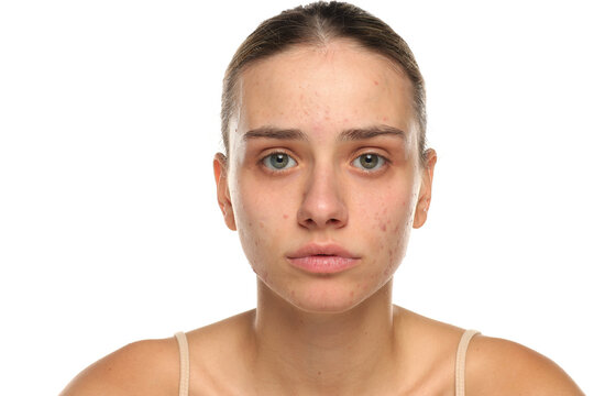 Studio shot of young woman with acne looking slightly worried, face skin condition, skincare concept