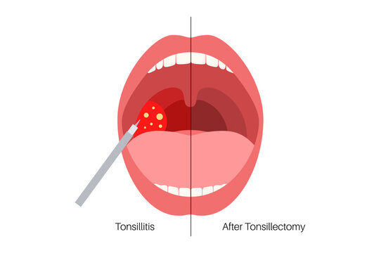 Tonsillectomy procedure poster
