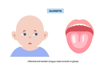 Glossitis medical poster
