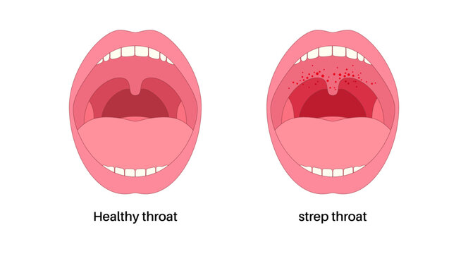 Strep throat poster