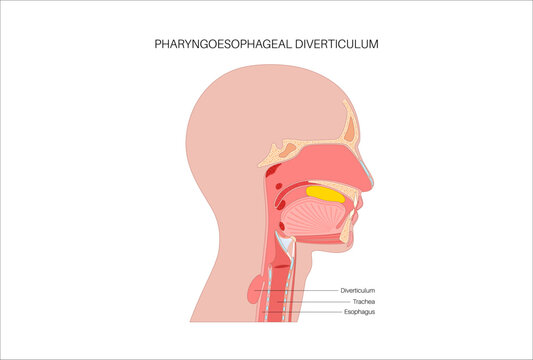Pharyngoesophageal diverticulum poster