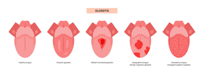 Tongue disease poster
