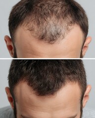Obraz premium A head with hair loss in patches compared to a head that always has full hair.