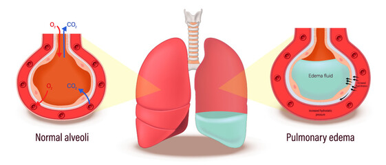 Pulmonary edema. Comparison between normal alveoli and pulmonary edema. Lung diseases anatomy. Human respiratory system.