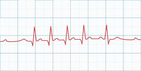 Medical heart rate monitoring displayed on an ECG or EKG graph with a clear pulse line.