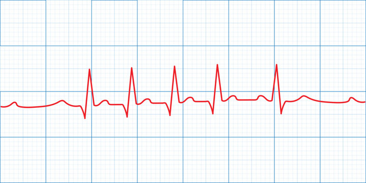 Medical heart rate monitoring displayed on an ECG or EKG graph with a clear pulse line.