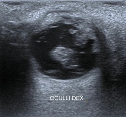 Globe rupture, orbita traumatic, USG ,ultrasound image Globe rupture, orbita traumatic, USG...