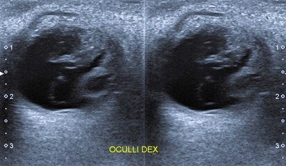Globe rupture, orbita traumatic, USG ,ultrasound image Globe rupture, orbita traumatic, USG ,ultrasound image ,showing collapsed anterior chamber, disruption of the eyeball (bulbus occuli),  © therads