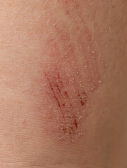 A person's arm has a red mark on it