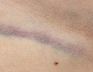 A person has a bruise on their arm