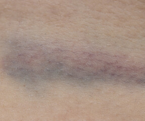 A person's arm with a bruise