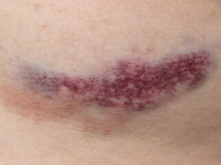 A bruise on a person's arm
