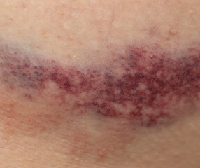 A bruise on a person's arm
