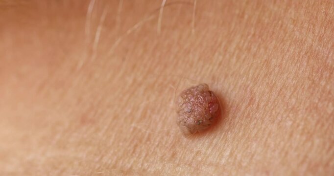 Red mole, growth, wart papilloma, nevus on armpit skin woman, banner medical dermatology.