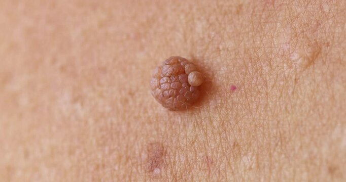 Red mole, growth, wart papilloma, nevus on armpit skin woman, banner medical dermatology.