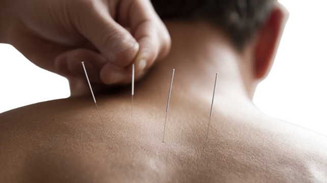 Close-up of acupuncture treatment on a person's back. transparent background