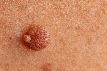 Mole big wart on skin woman. Concept dermatology body diseases papilloma or melanoma, Oncology...