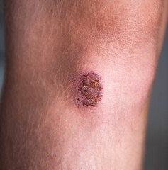 Close-up view of a skin lesion on a human arm, showcasing texture and color variations,...