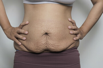 woman postpartum belly with stretch marks, problem after giving birth. promoting body positivity...