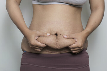 woman squeeze her postpartum belly with stretch marks, problem after giving birth. promoting body...