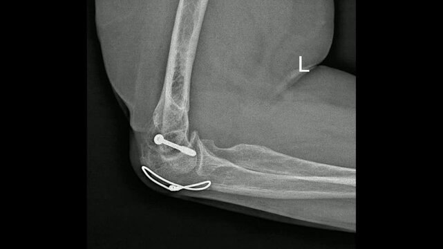 X-ray shows a left elbow with internal fixation of an olecranon fracture using tension band wiring (TBW)