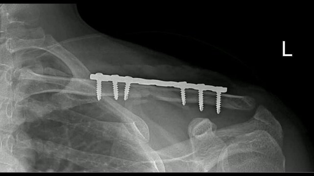 X-ray image shows a post-operative clavicle (collarbone) with internal fixation