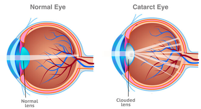 Cataract anatomy. Clouding of the eye&rsquo;s lens which often results in blurry or hazy vision.  Brown iris diagram.  Vector illustration	