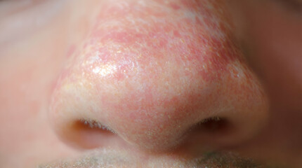 Fototapeta premium Close-Up View of Human Nose with Redness and Skin Irritation, Diagnostic Skin Condition in Dermatology, Close-up Photography of Skin Texture and Issues