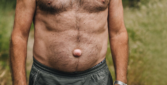 Photograph of an elderly man, grandfather with a large umbilical hernia inherited. Concept of disease.