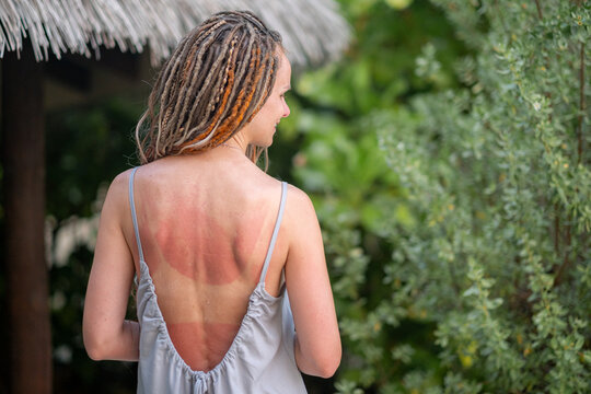 Back of a woman with visible sunburn lines and tan marks from swimsuit, standing outdoors in strappy summer dress, skin damage after beach vacation, sun care, travel and skincare