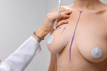 Plastic Surgeon Marking Breasts Before Mammoplasty Augmentation and Lift Preoperative Planning...